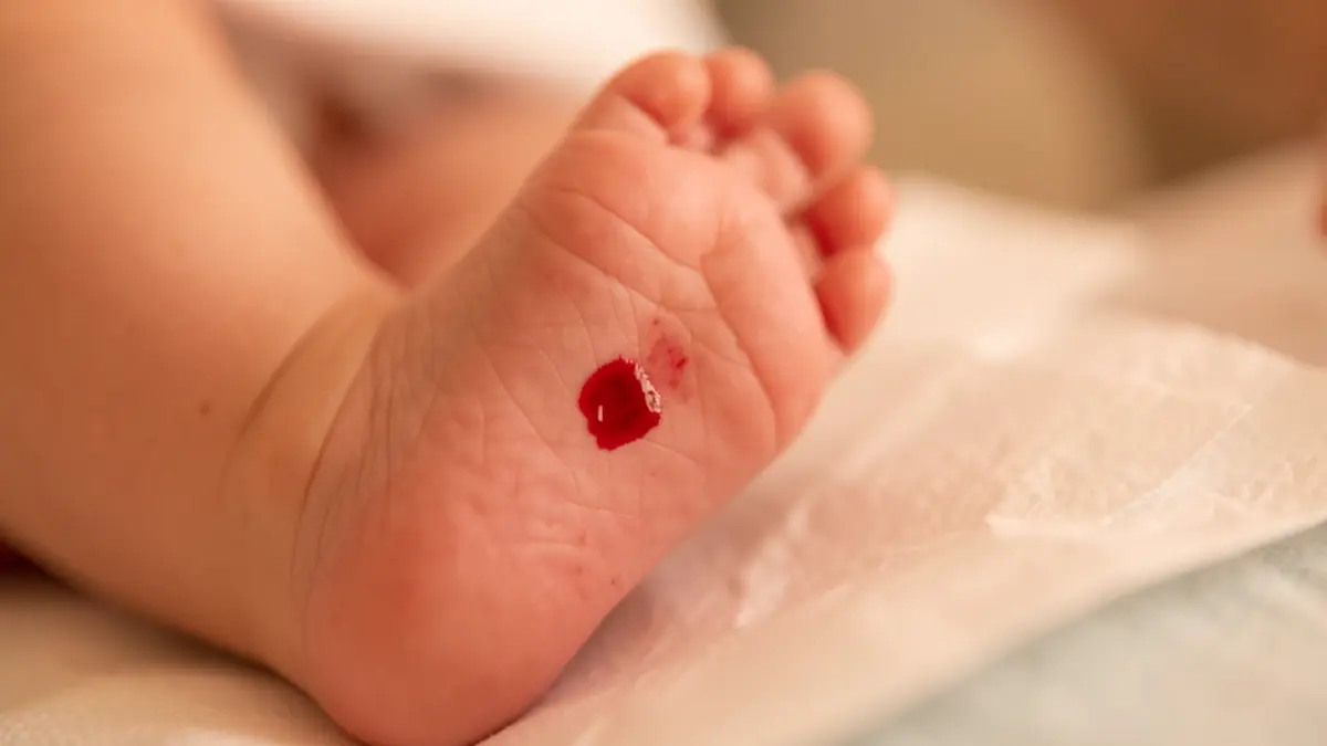 Muestra de sangre de un recién nacido para cribado neonatal.